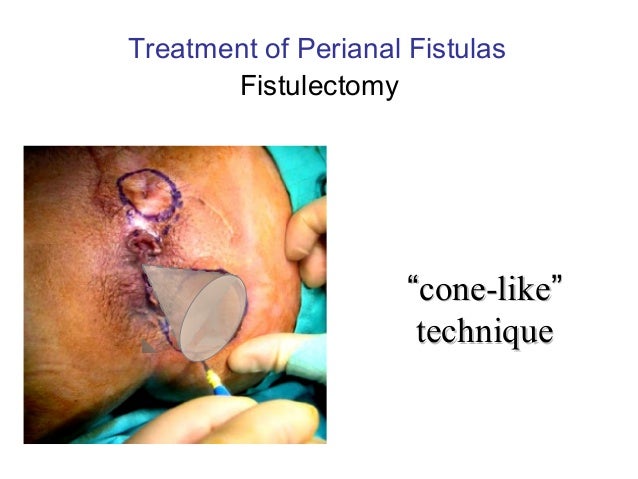 complex anal fistula disease Anal cum swappers v goofs